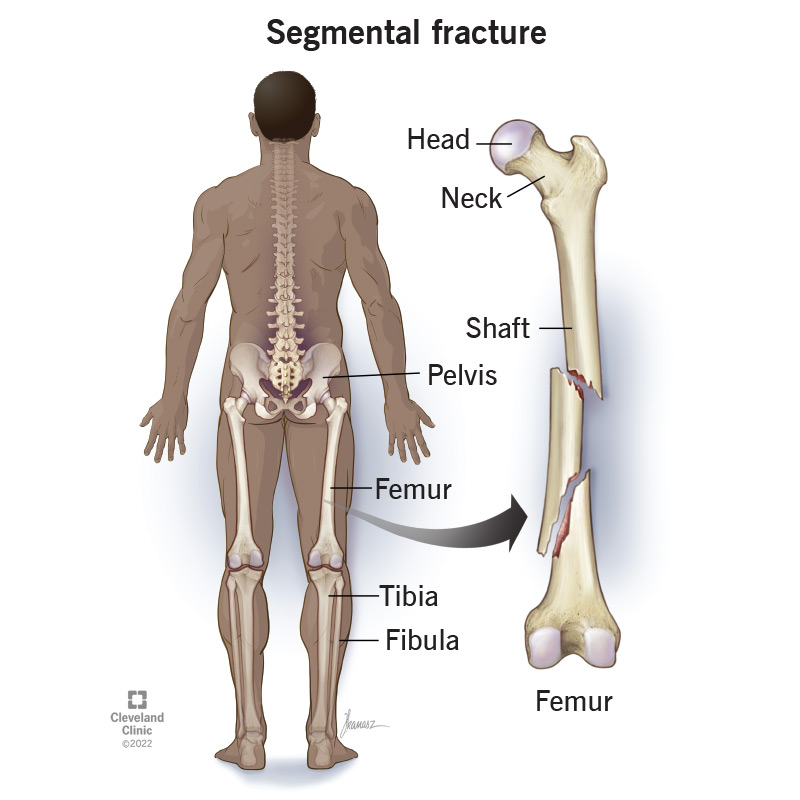 22234 segmental fracture