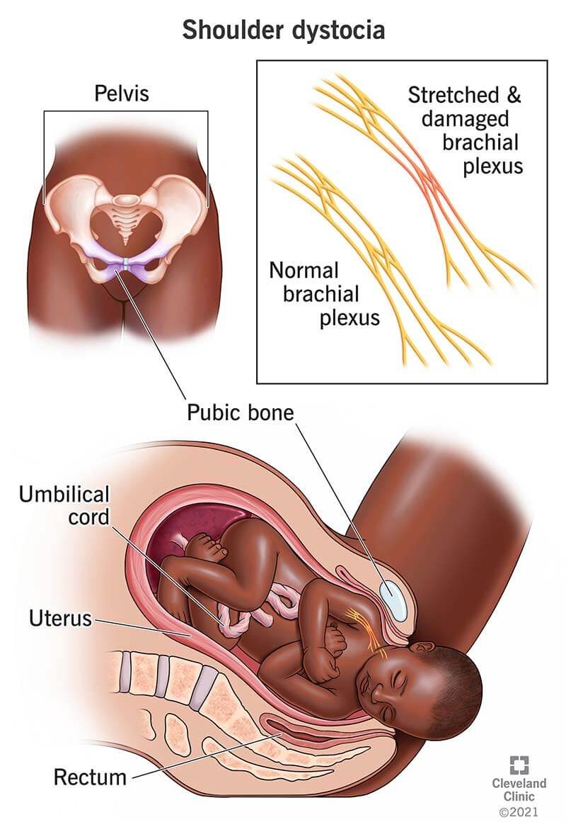 I nervi del plesso brachiale del tuo bambino possono essere danneggiati a causa della distocia della spalla durante il parto