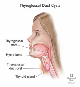 22351 thyroglossal duct cysts