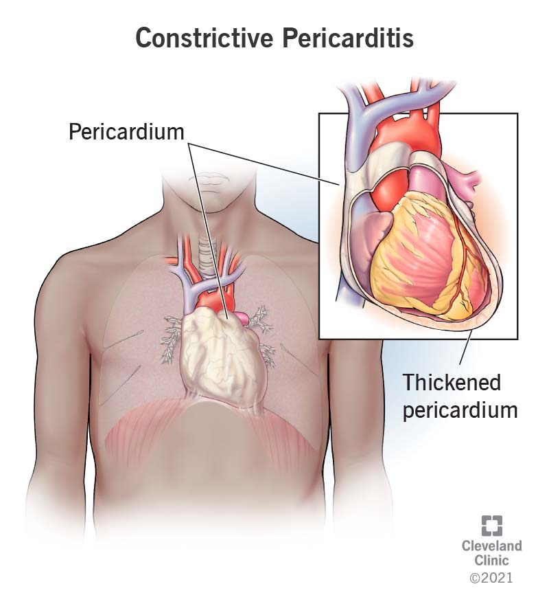 22373 constructive pericarditis