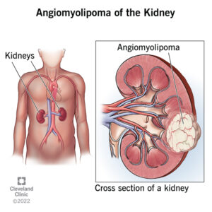 22415 angiomyolipoma kidney