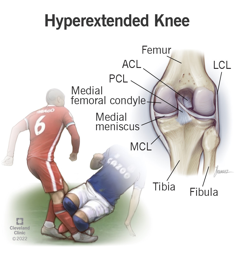 22481 hyperextended knee