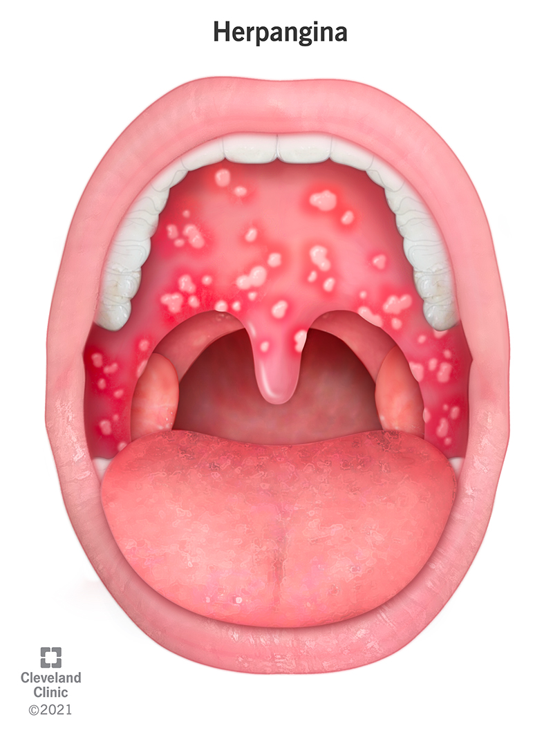 L'Herpangina è un virus che causa la formazione di piccole vescicole all'interno della bocca del bambino.  Queste vesciche sembrano protuberanze bianche o brufoli che compaiono sul palato del tuo bambino, all'interno delle guance e in gola.