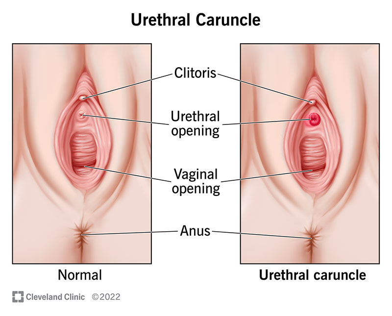 22621 urethral caruncle