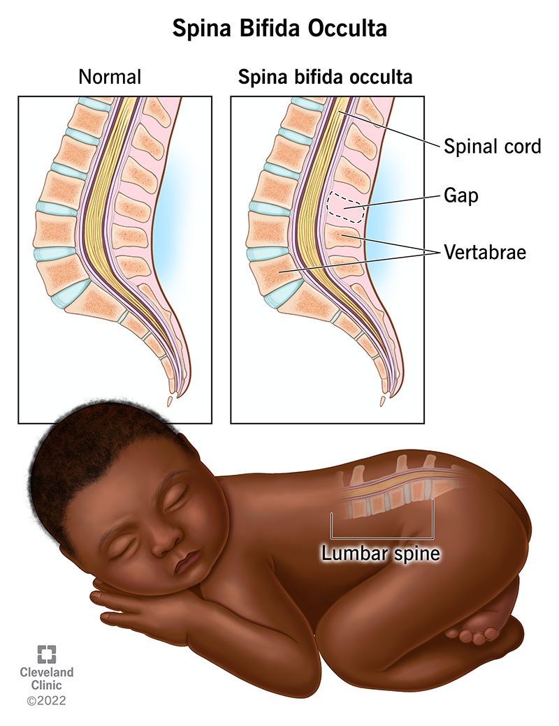 Un bambino affetto da spina bifida occulta ha uno spazio tra le vertebre della colonna lombare, che si trova nella parte inferiore della schiena.