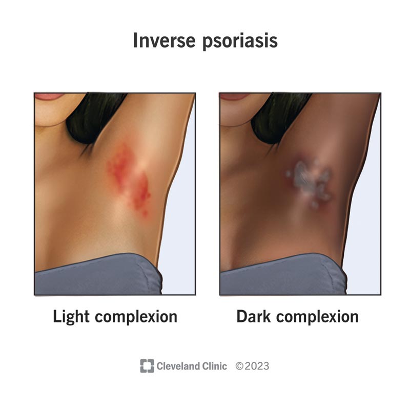 22852 inverse psoriasis