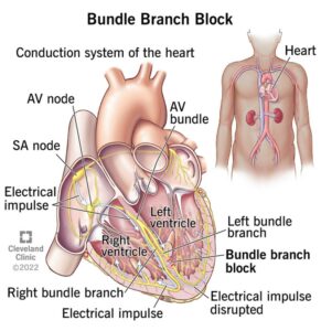 22938 bundle branch blocker