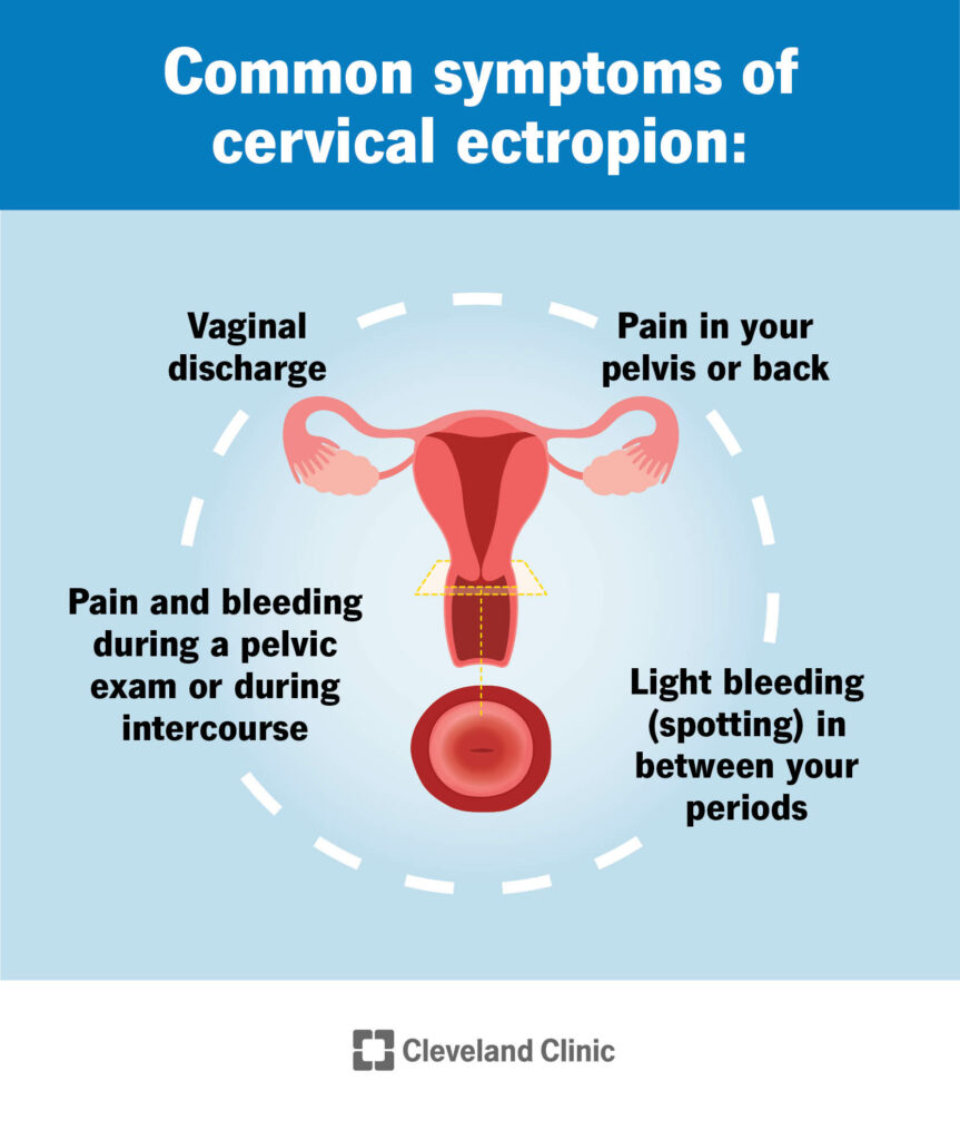 23053 cervical ectropion