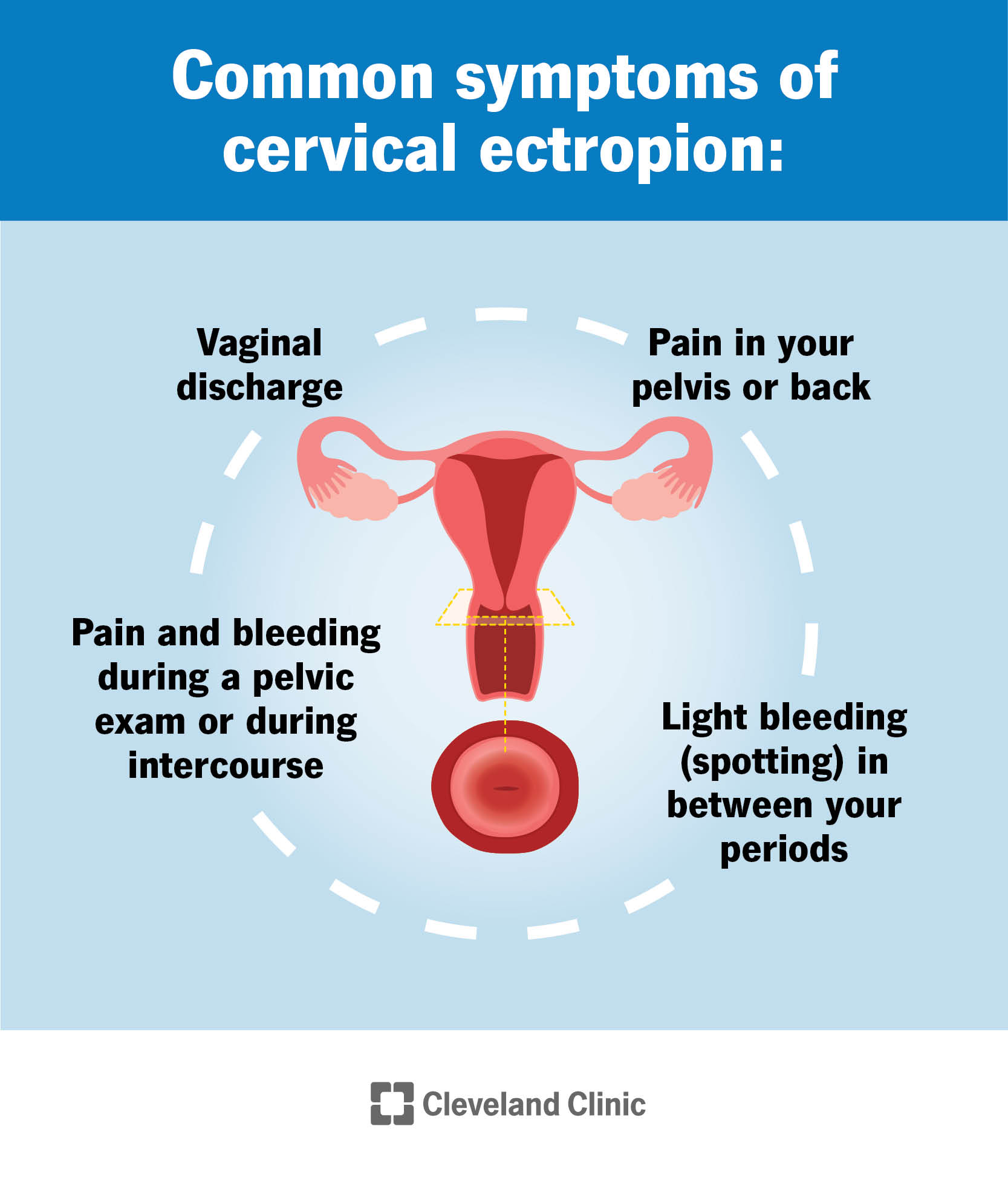Sistema riproduttivo di una persona assegnata come femmina alla nascita, con particolare attenzione alla cervice.  Il testo di accompagnamento riassume i sintomi comuni dell'ectropion cervicale.