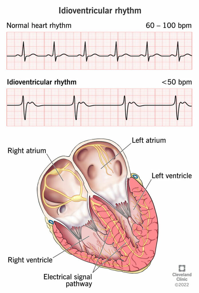 23070 idioventricular rhythm