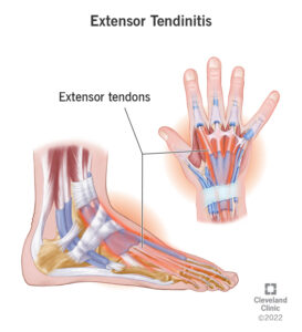 23126 extensor tendinitis