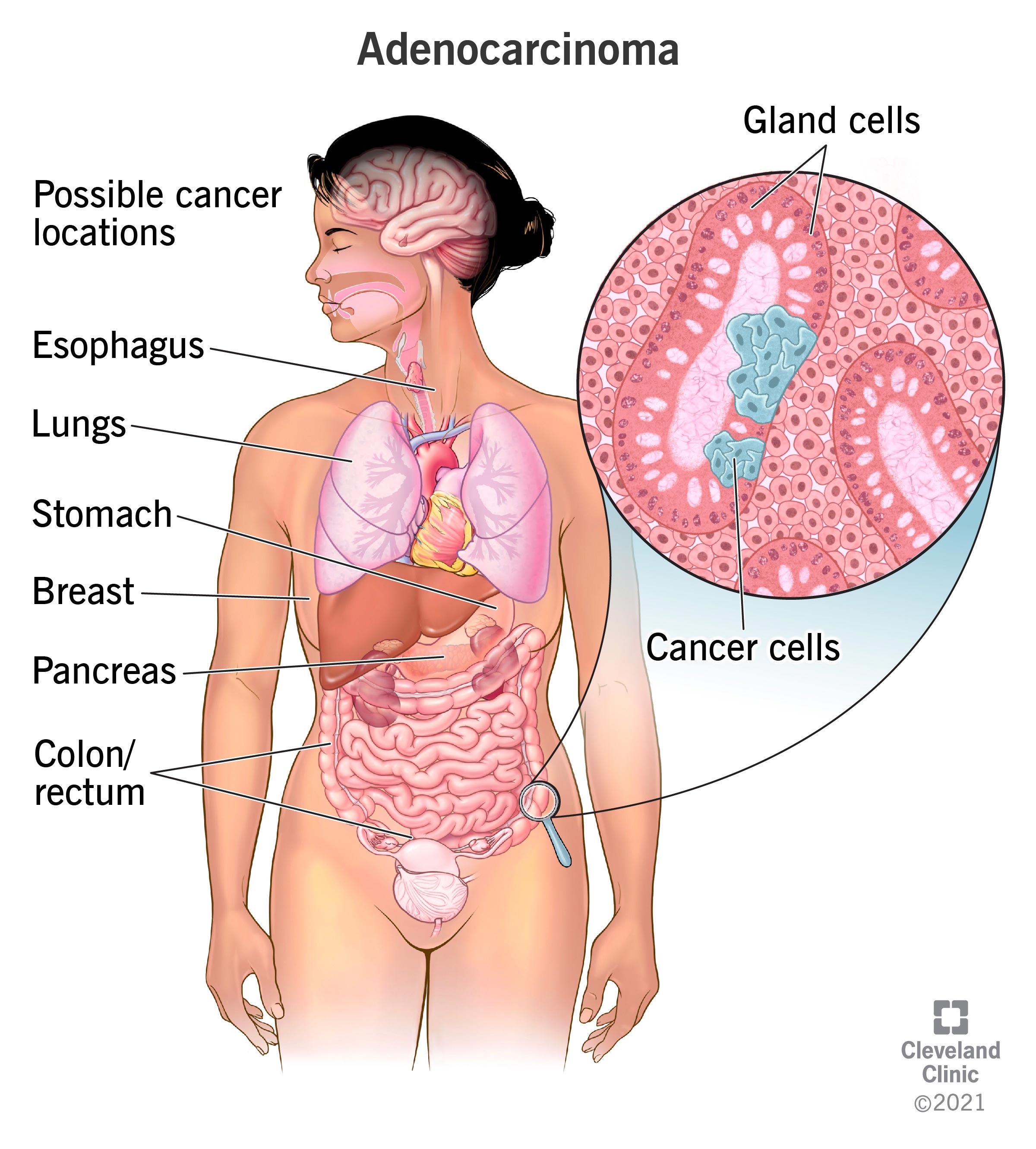 Cellule tumorali che si formano nelle cellule epiteliali ghiandolari che rivestono il colon.