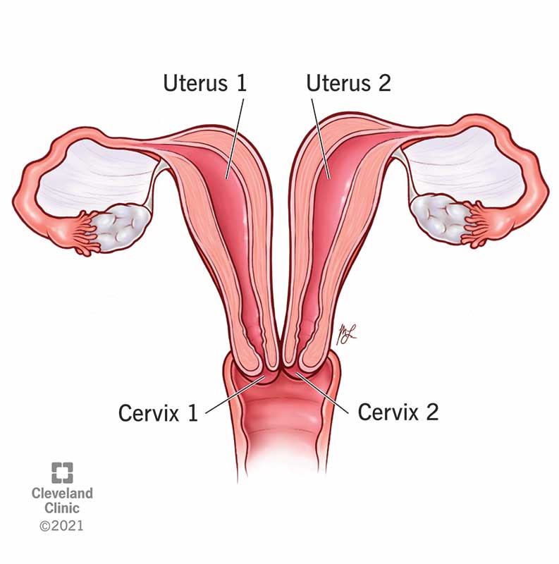 23301 uterus didelphys