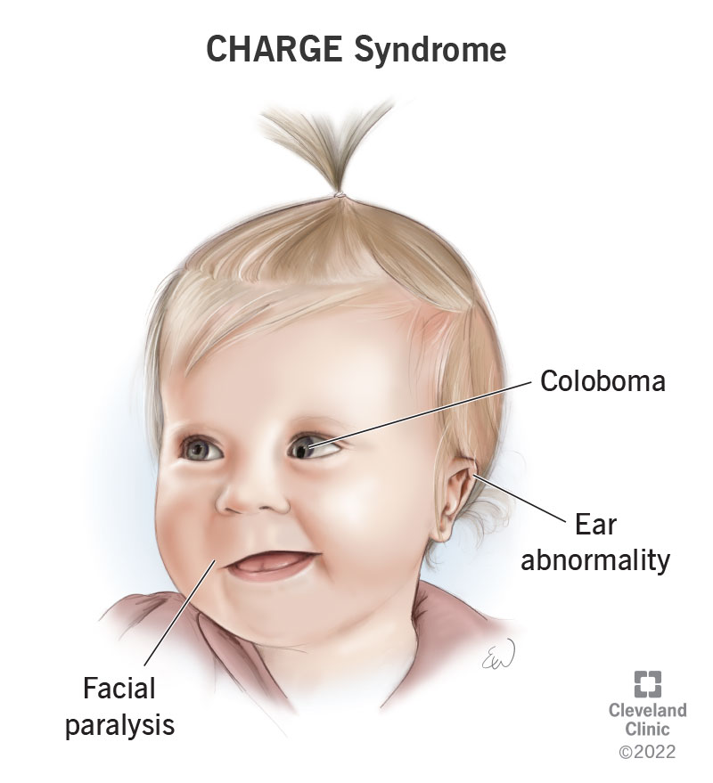 23472 CHARGE syndrome