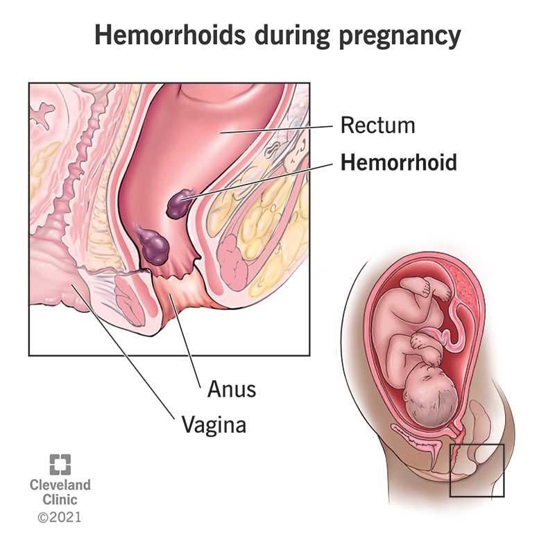 23498 pregnancy hemorrhoids