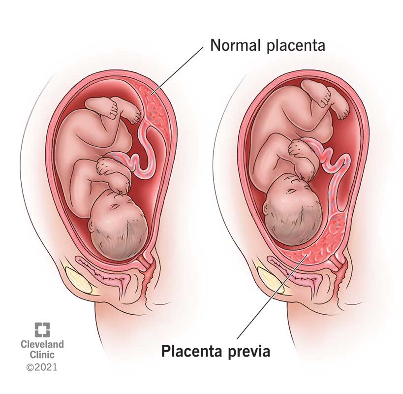 24211 placenta previa