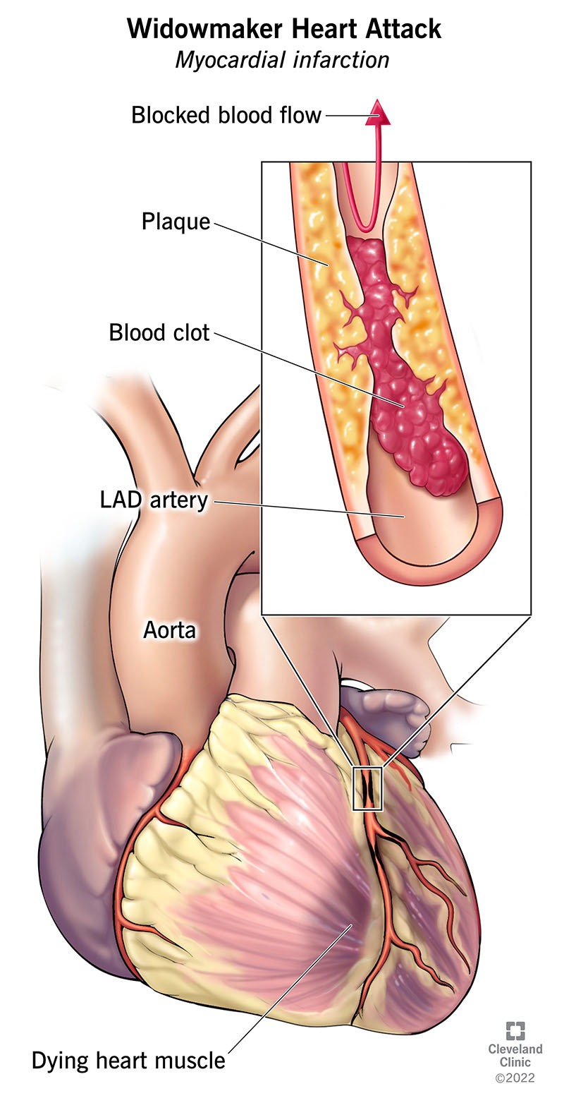Un attacco cardiaco da vedovo coinvolge l'arteria discendente anteriore sinistra, che fornisce la maggior parte del muscolo cardiaco.