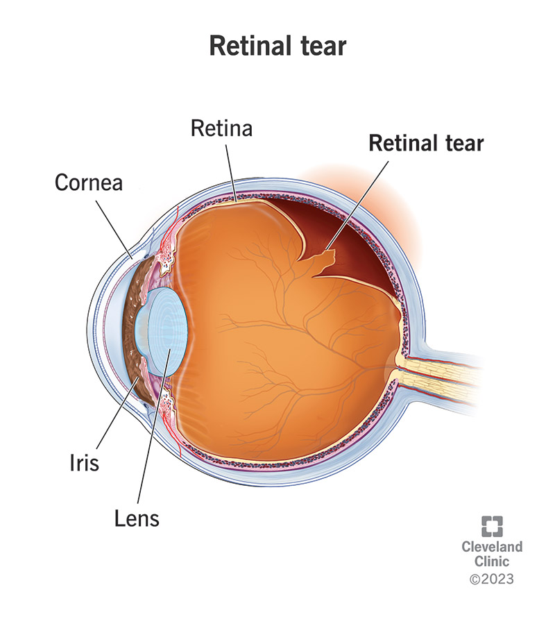 25107 retinal tear