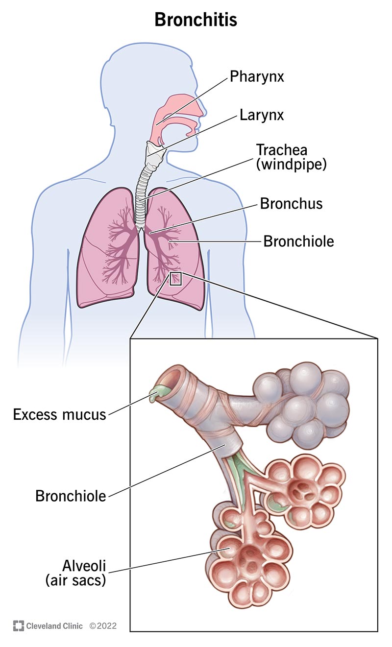 Immagine che mostra l'anatomia dei polmoni.  I tuoi bronchi hanno un eccesso di muco quando hai la bronchite.