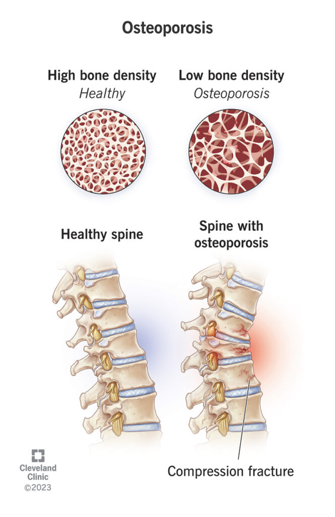 4443 osteoporosis