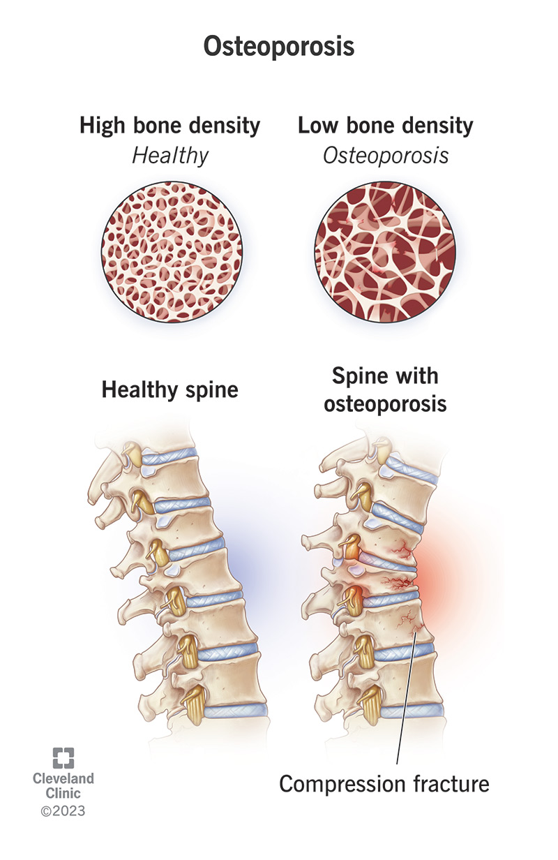 Una colonna vertebrale sana rispetto a una colonna vertebrale con bassa densità ossea e fratture da compressione.
