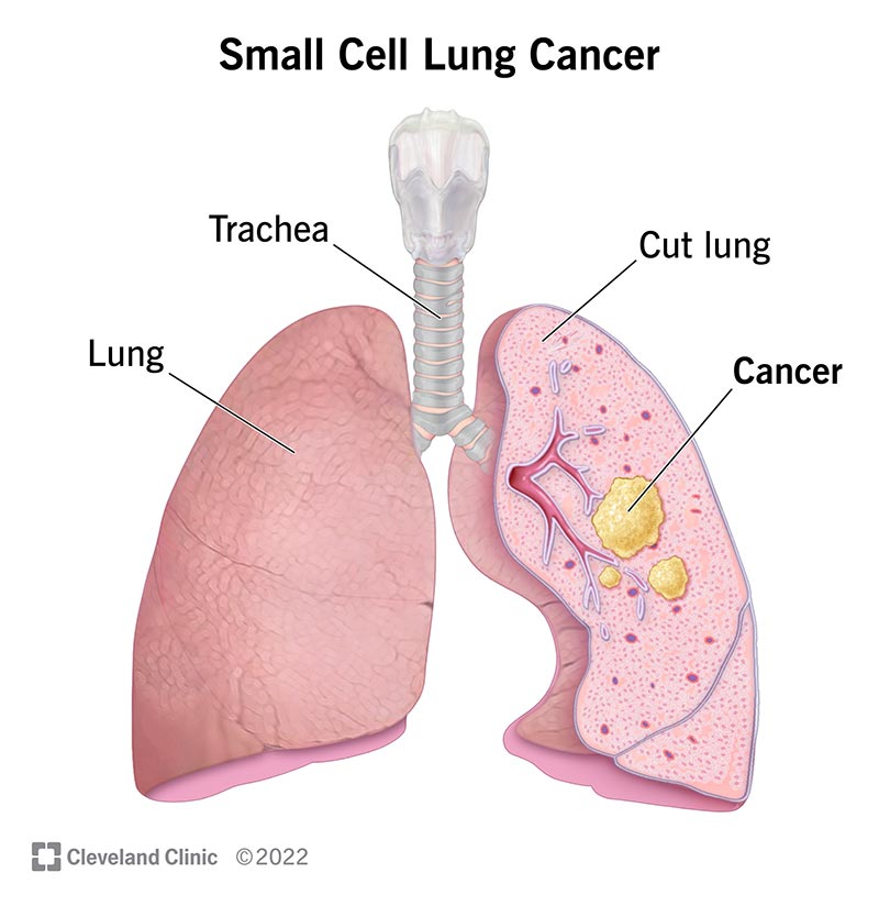 6202 small cell lung cancer