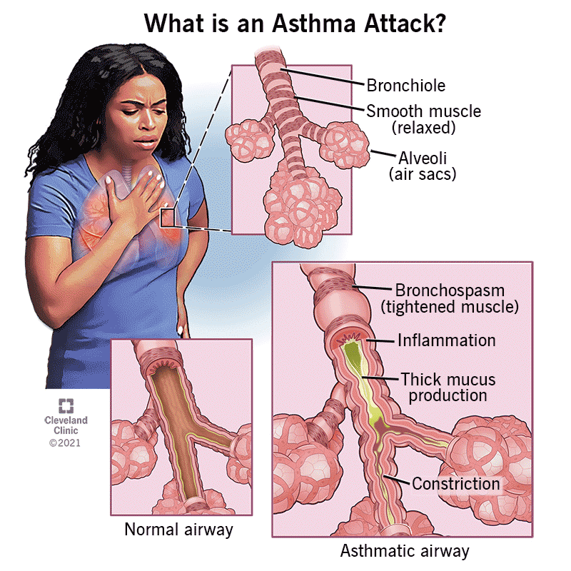 6424 asthma