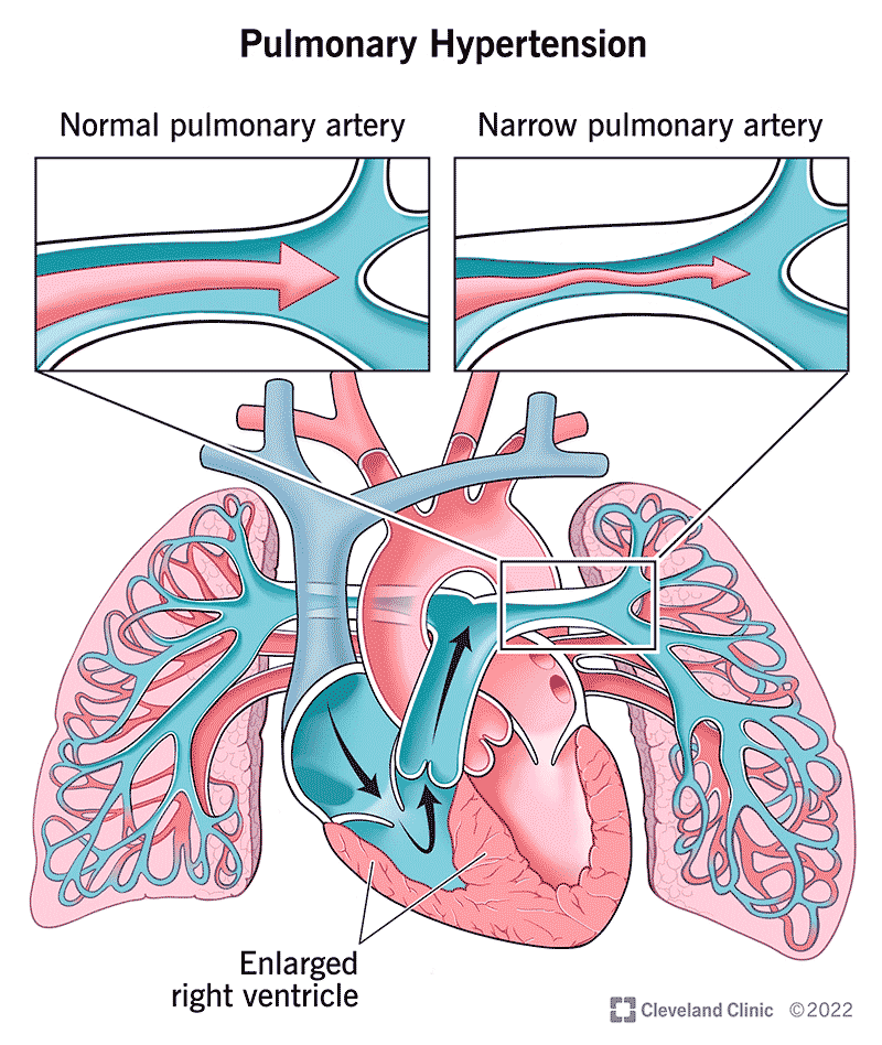 6530 pulmonary hypertension