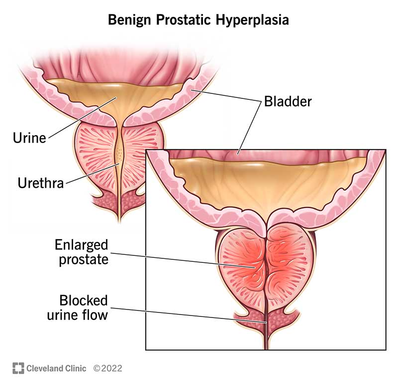 9100 benign prostatic hyperplasia