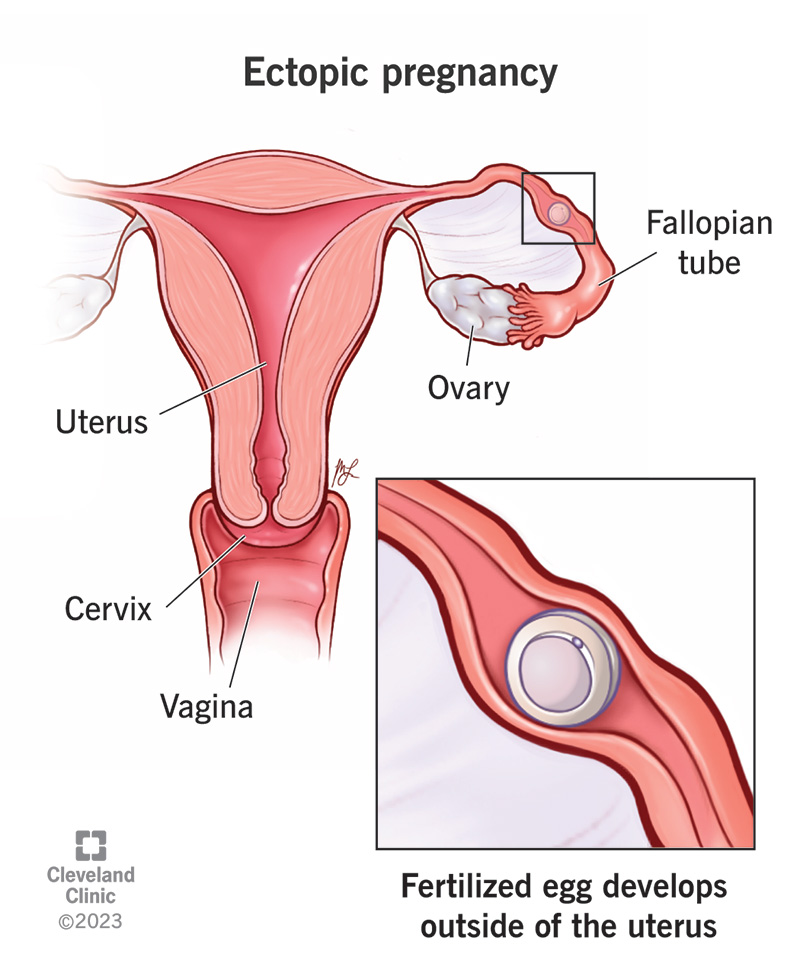 9687 ectopic pregnancy