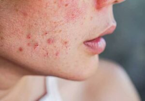 Hormonal Acne Period 1270415883 770x533 1 jpg