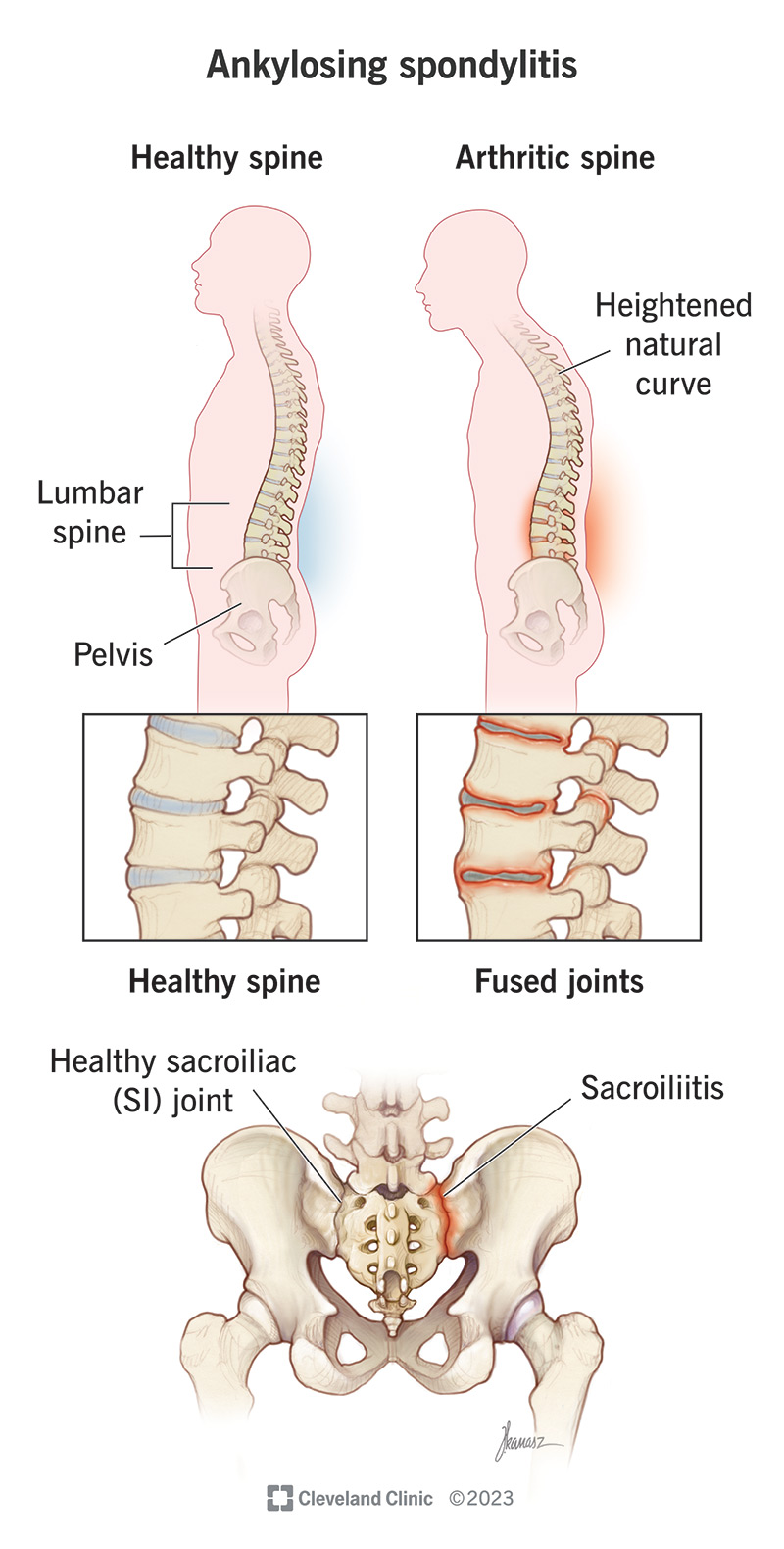 La spondilite anchilosante di solito colpisce le articolazioni sacroiliache (dove la base della colonna vertebrale incontra il bacino).