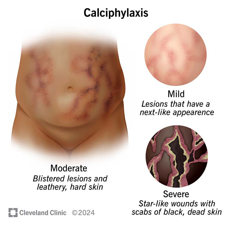 calciphylaxis illustration