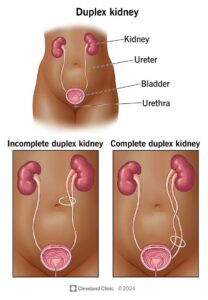 duplex kidney