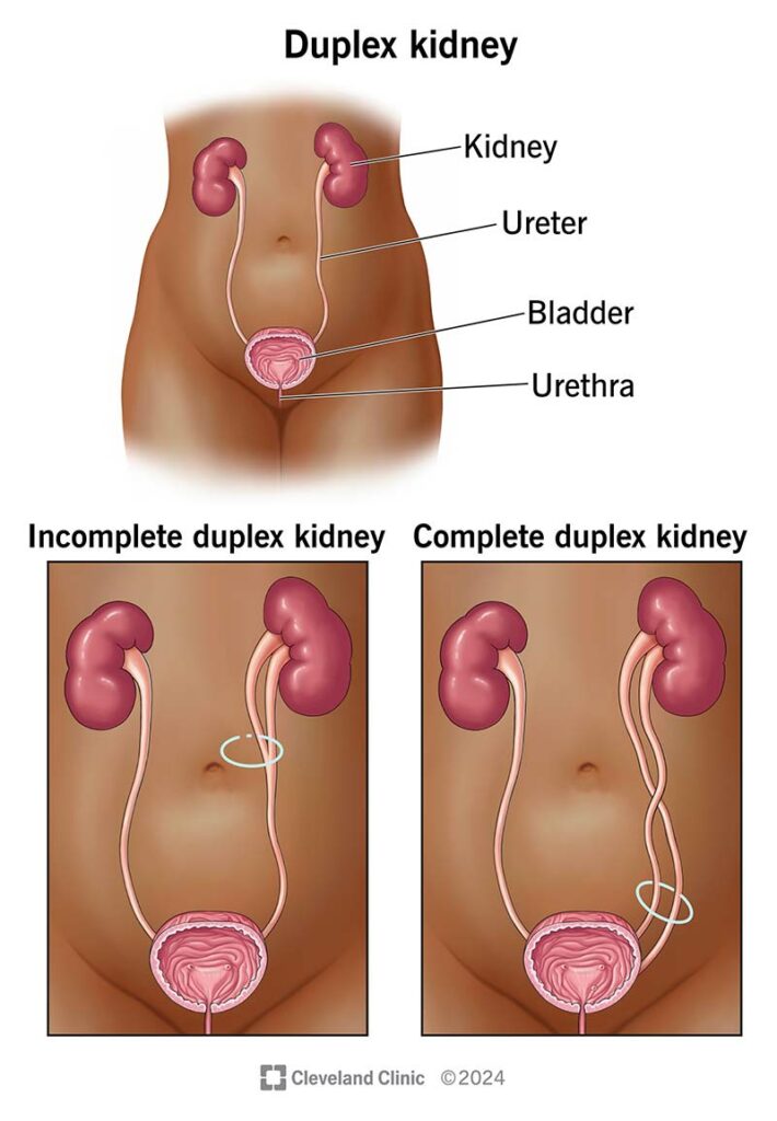 duplex kidney