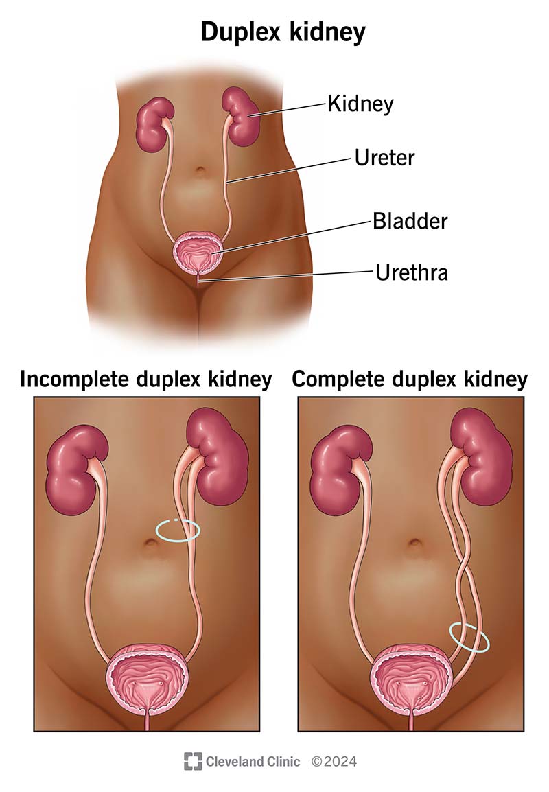 L'immagine mostra un rene duplex incompleto o due ureteri che si uniscono prima della vescica e un rene duplex, due ureteri separati.