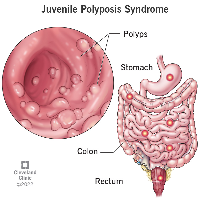 juvenile polyposis syndrome