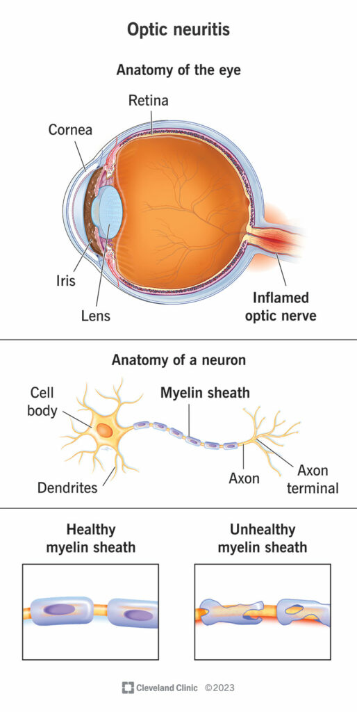 optic neuritis