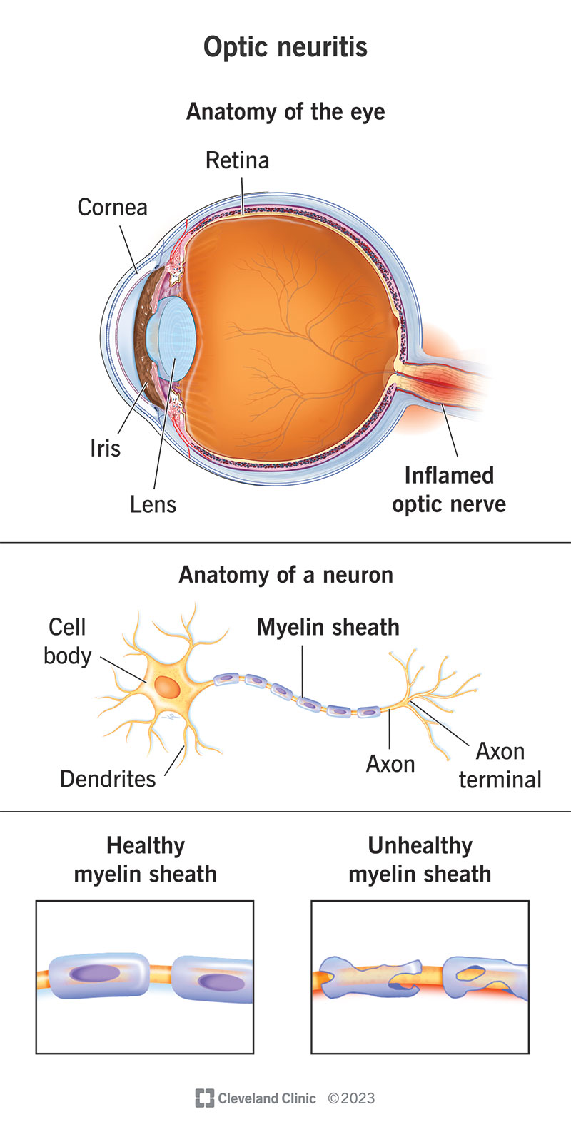 Neurite ottica, anatomia dell'occhio, anatomia di un neurone, guaina mielinica sana e malsana