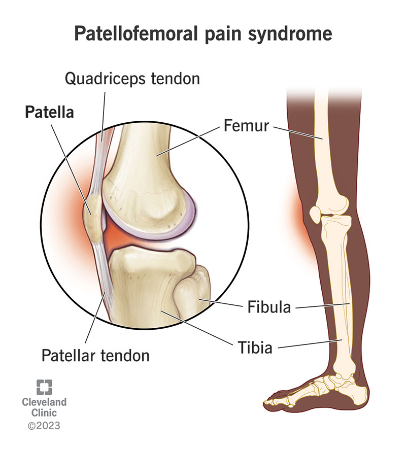 patellofemoral pain syndrome