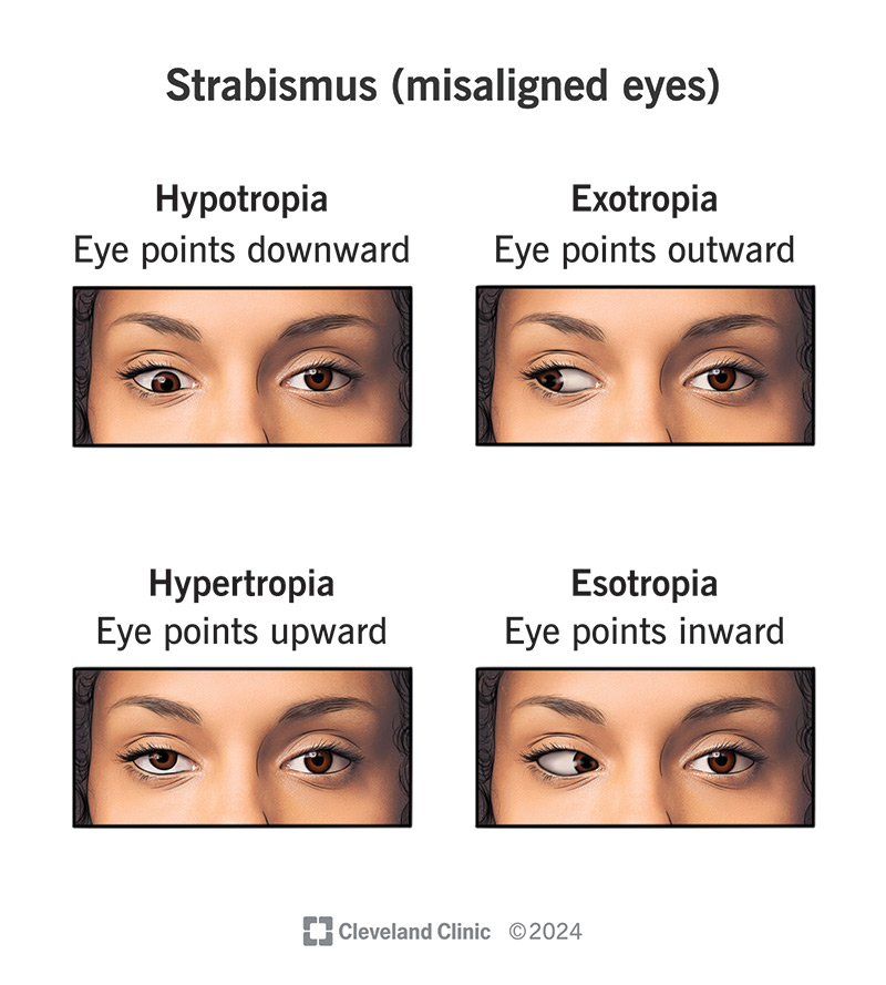 strabismus eye misalignment