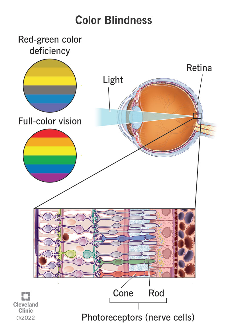 Illustrazione dell'occhio che mostra la posizione della retina e delle sue cellule nervose specializzate (fotorecettori).  Un'illustrazione a lato confronta i colori che una persona vede con carenza di colore rosso-verde rispetto alla visione a colori.