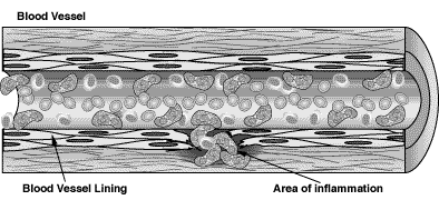 Illustrazione microscopica della poliangite