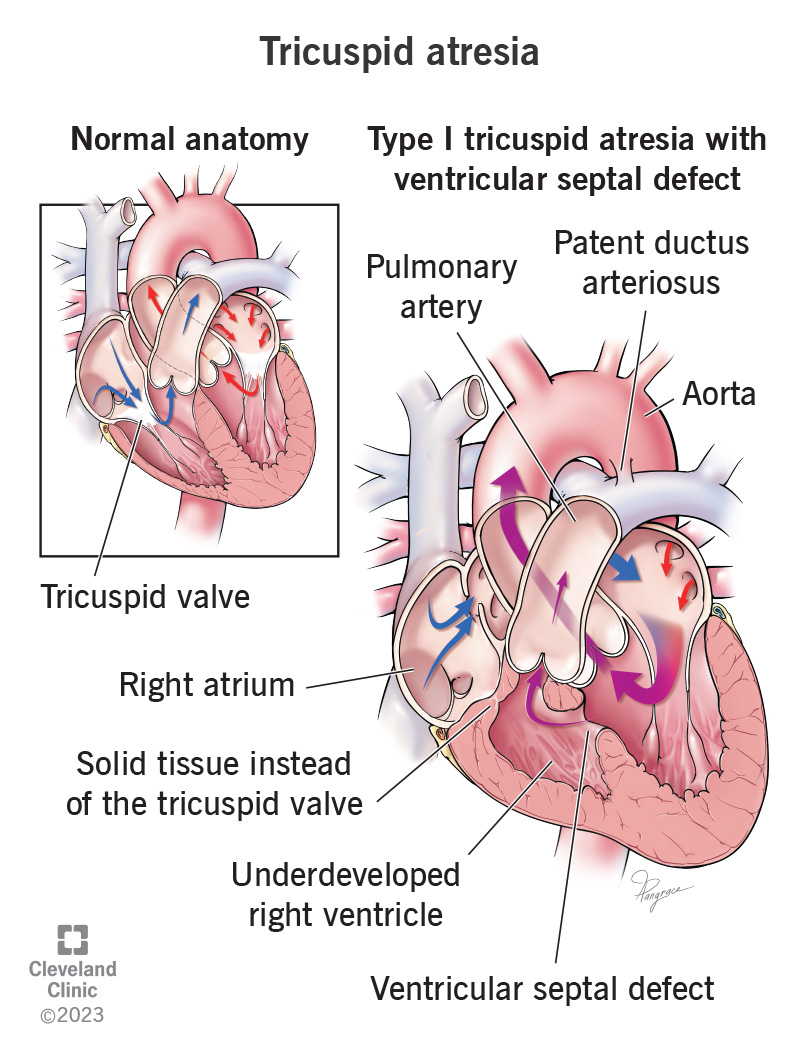 Anatomia cardiaca normale rispetto a un cuore con atresia tricuspide di tipo 1.