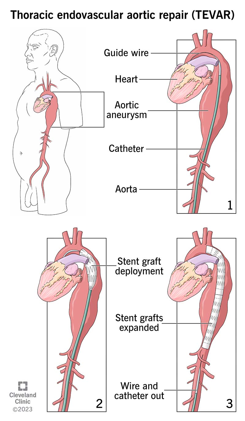 Il tuo fornitore utilizza un catetere per inserire uno stent nell'aorta e riparare un aneurisma.