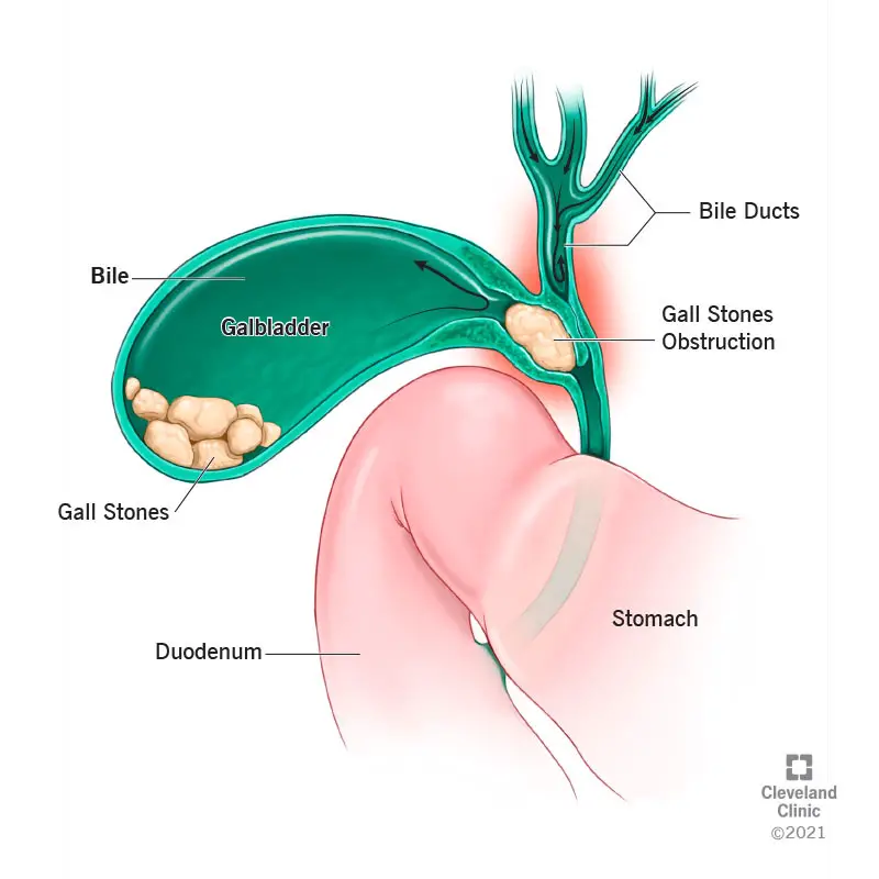 Un calcolo biliare nel collo della cistifellea che comprime il dotto biliare adiacente.