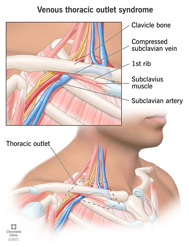 Compressione di vene e arterie tra la clavicola e la prima costola che causa la sindrome dello stretto venoso toracico.