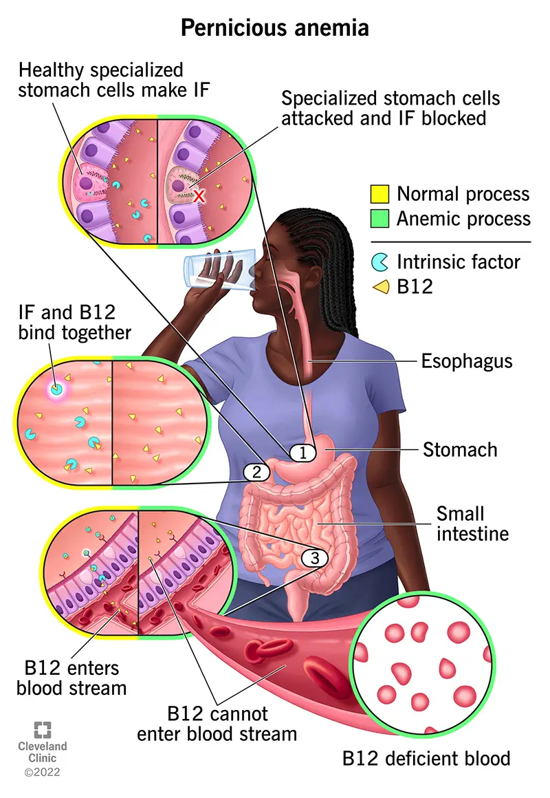 Donna che beve un liquido con inserto dell'apparato digerente (al centro). Dettaglio del processo di assorbimento normale e anormale della B-12 (a sinistra).