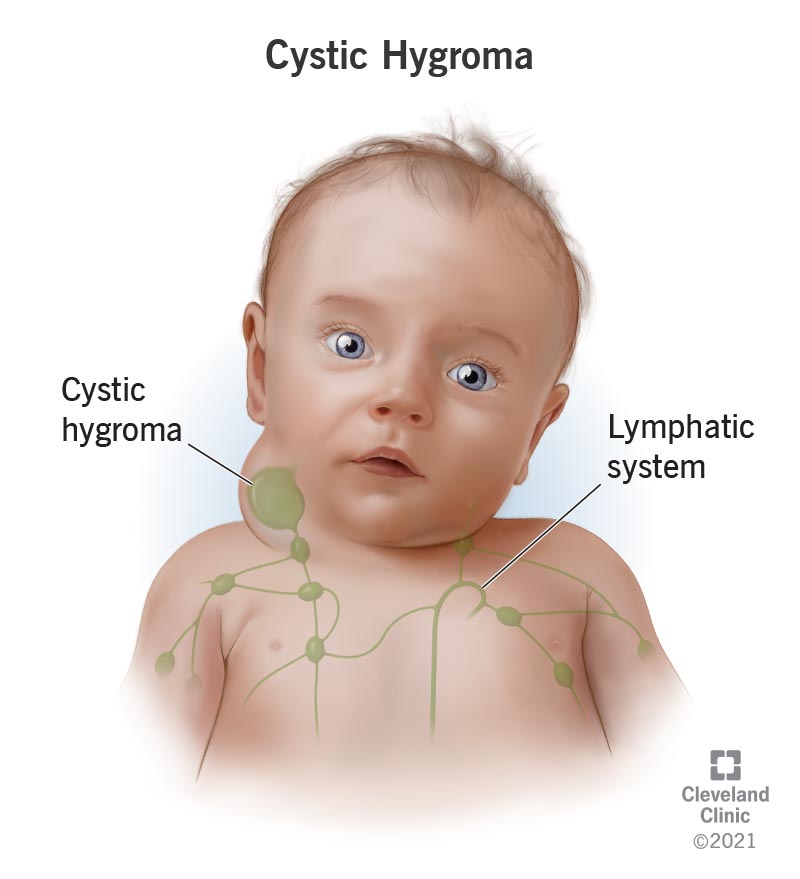 22492 cystic hygroma