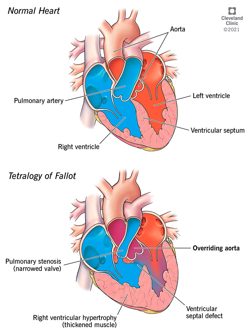 L'aorta principale si trova sopra il difetto del setto ventricolare.